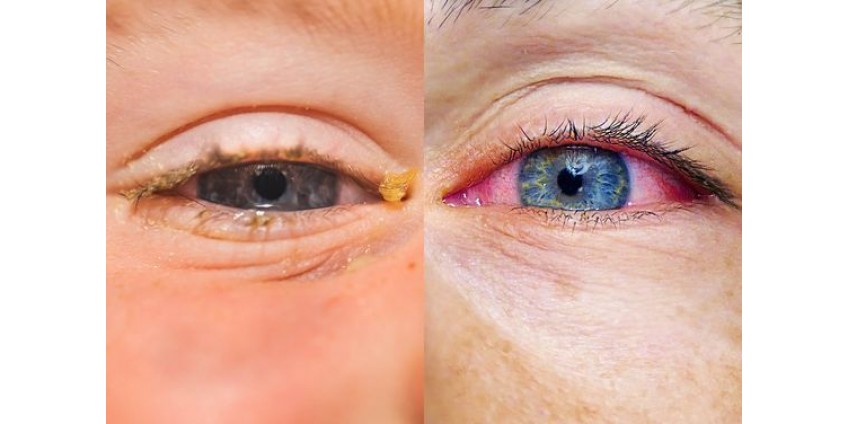 Beat Eye Allergies and Vitamin Deficiencies in less than a month 